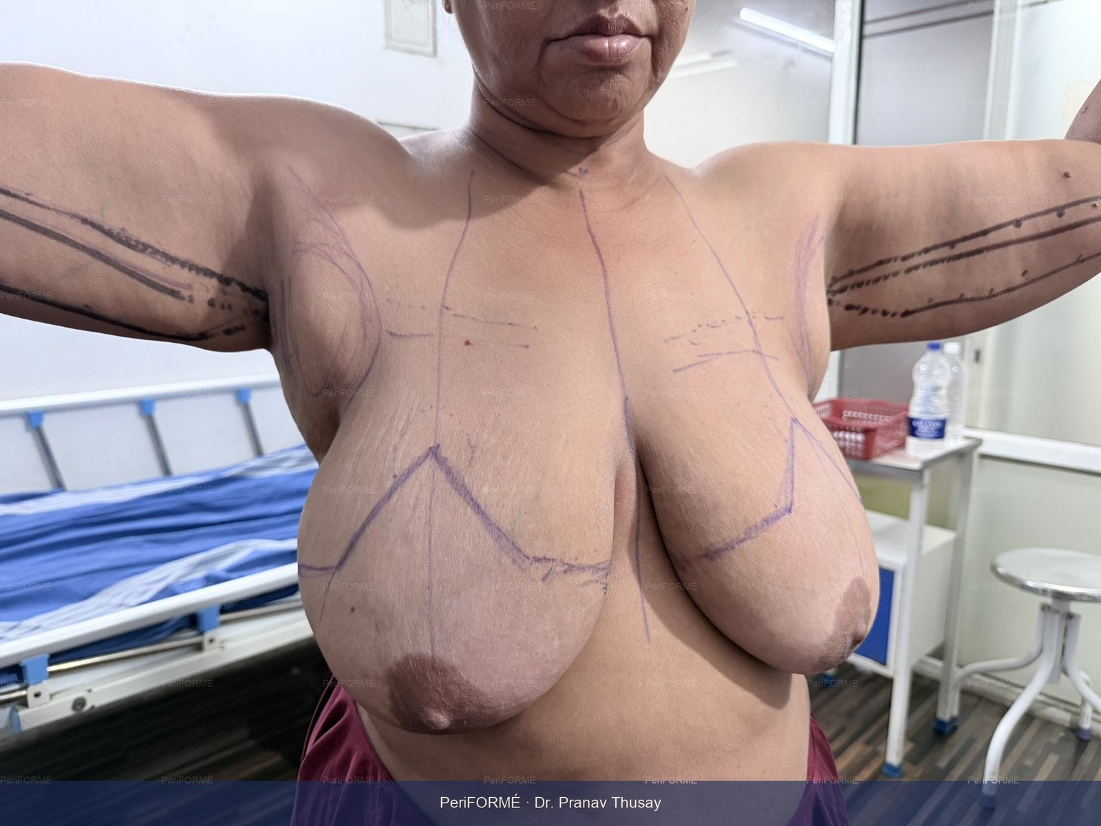 Arm lift and Breast reduction markings