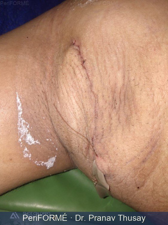 Axillary Breast After