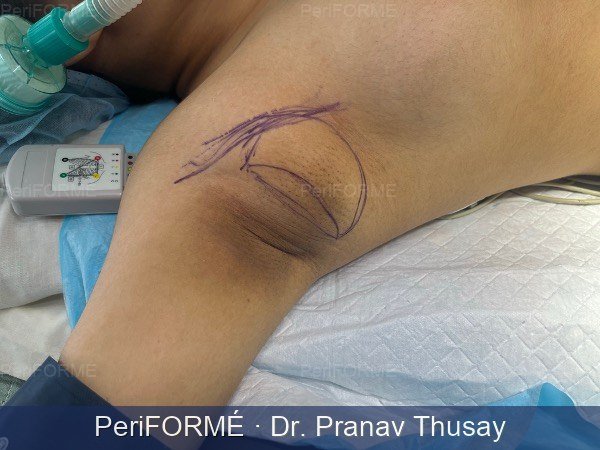 Axillary Breast Before
