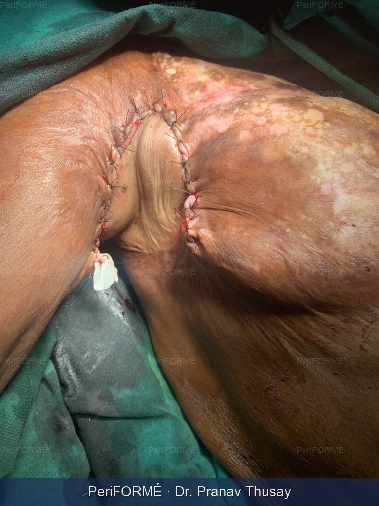 Axillary scar contracture release
