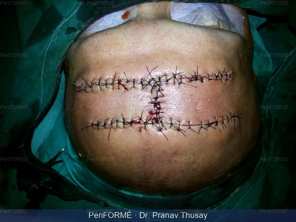 Bedsore surgery — After