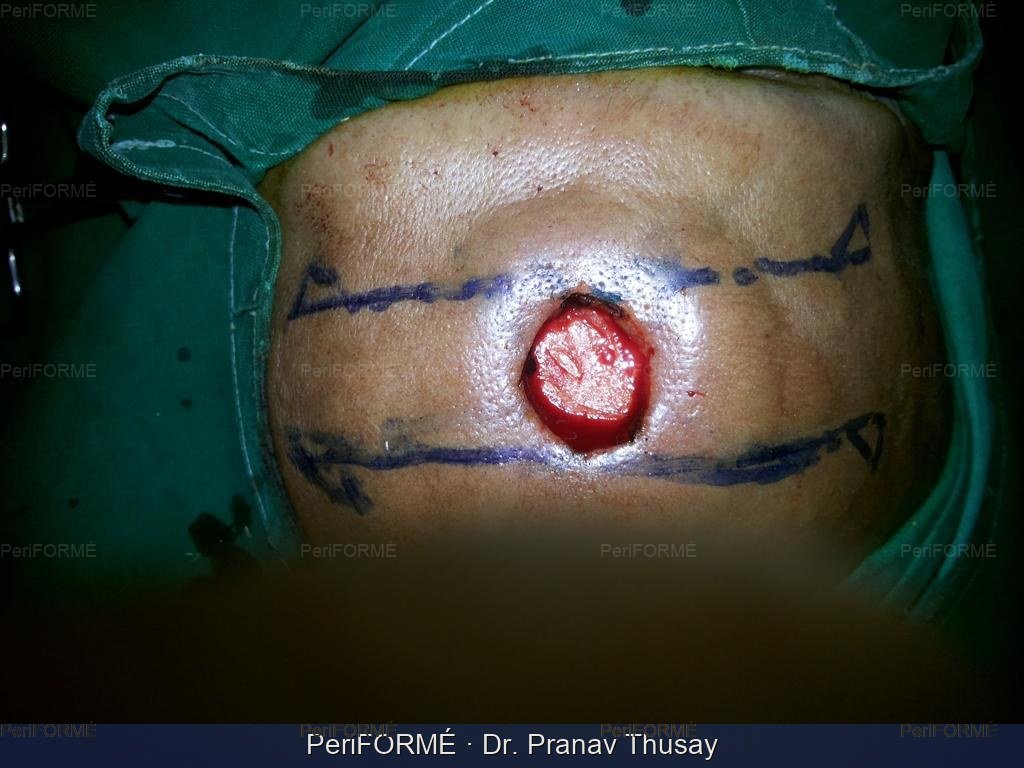 Bedsore surgery — Before