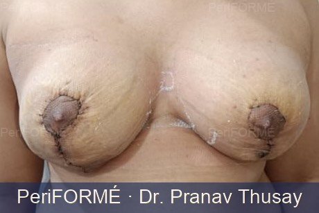 Breast Asymmetry After