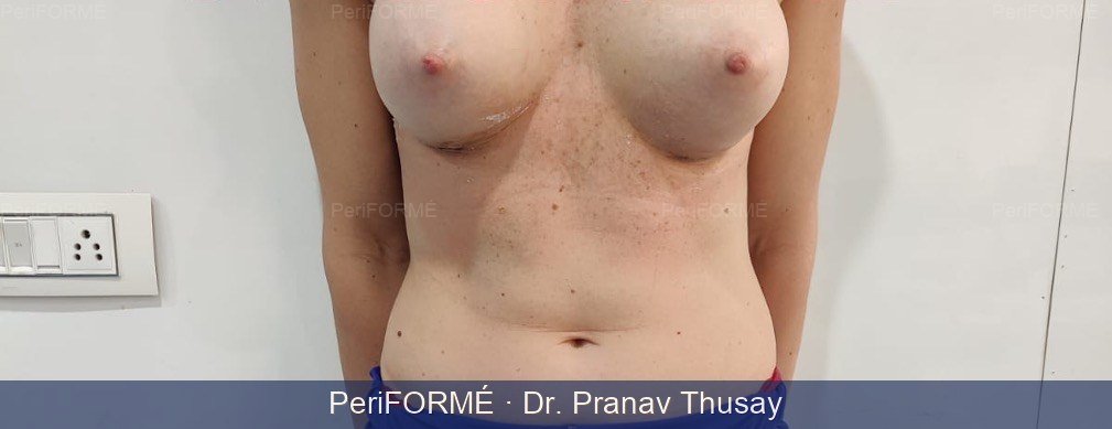 Breast Augmentation Result