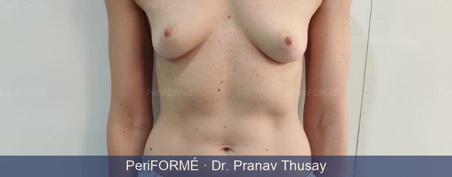 Breast Augmentation — Before