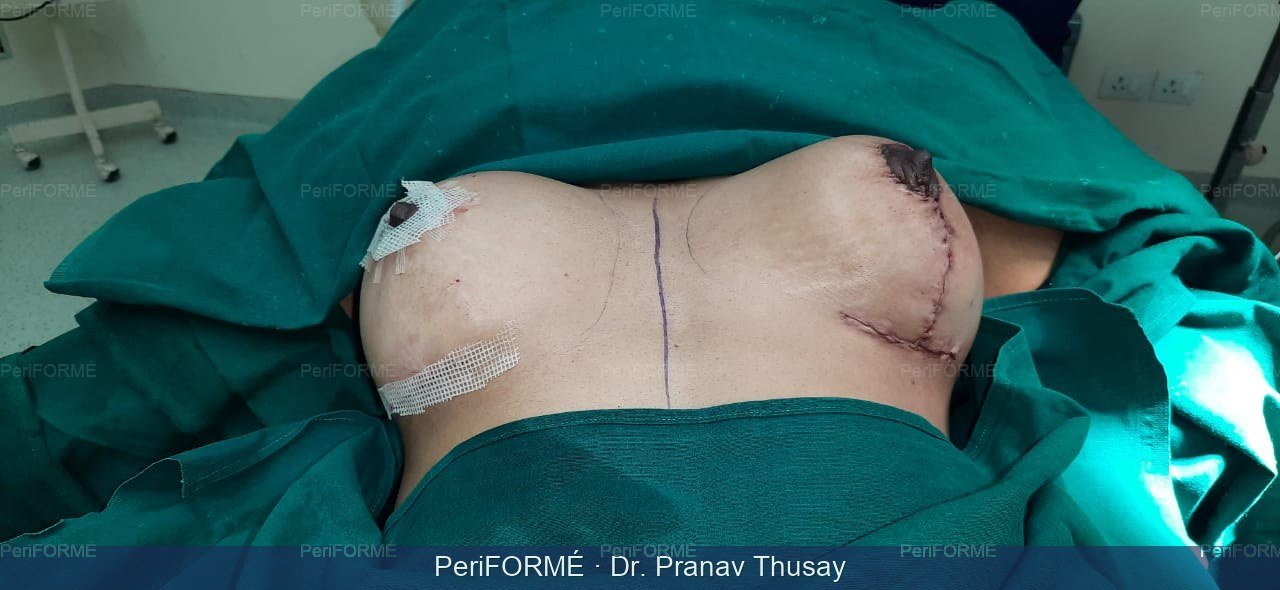 Breast implant + Breast lift - Breast symmetrization surgery — After