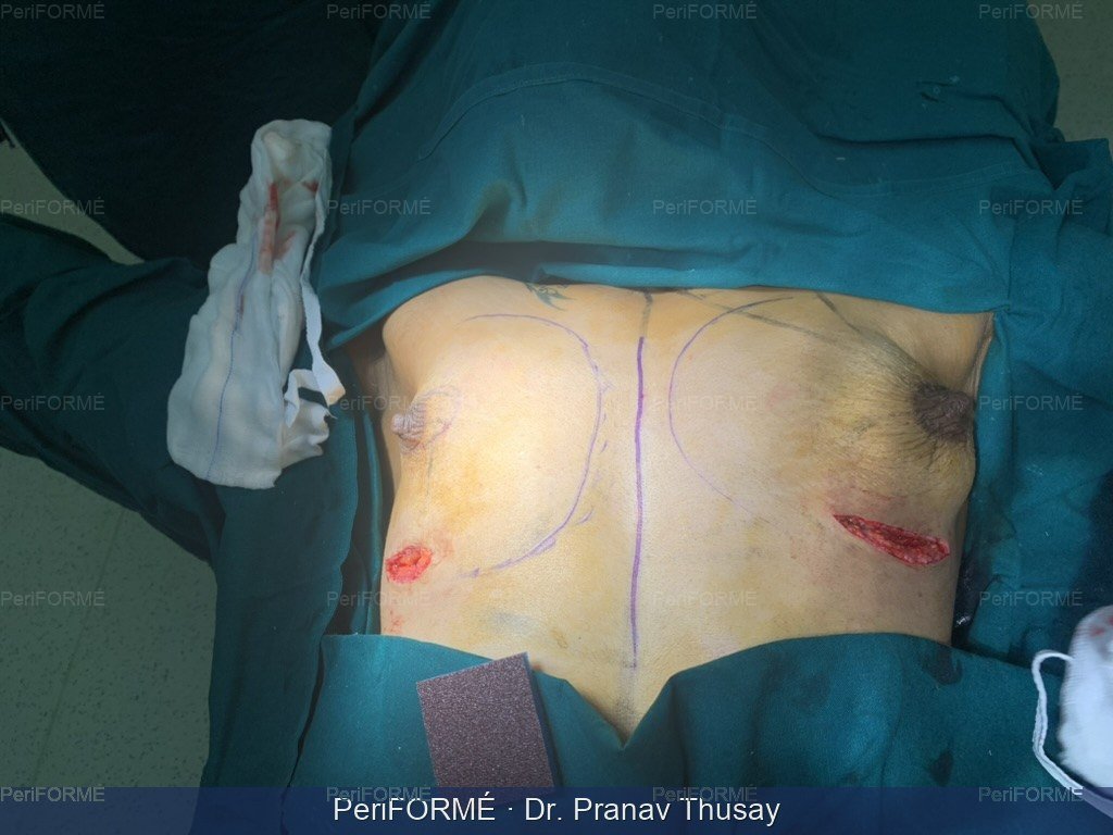 Breast implant + Breast lift - Breast symmetrization surgery — Before