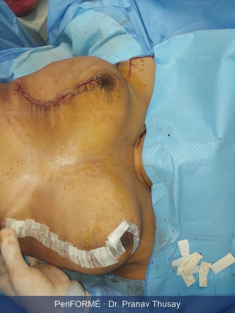 Breast lift — After