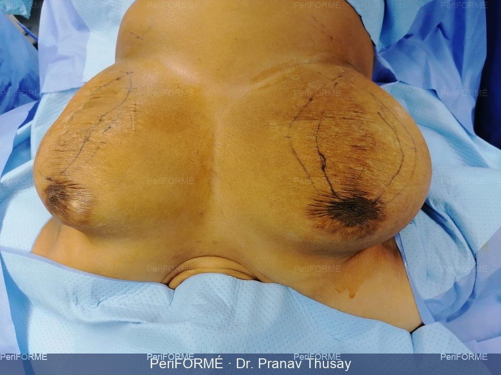 Breast lift — Before