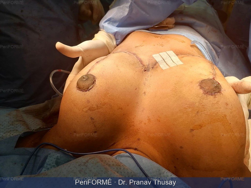 Breast Lift - during surgery pictures — After