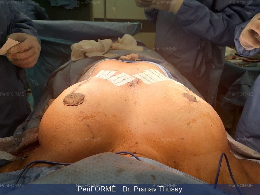 Breast Lift - during surgery pictures — Before