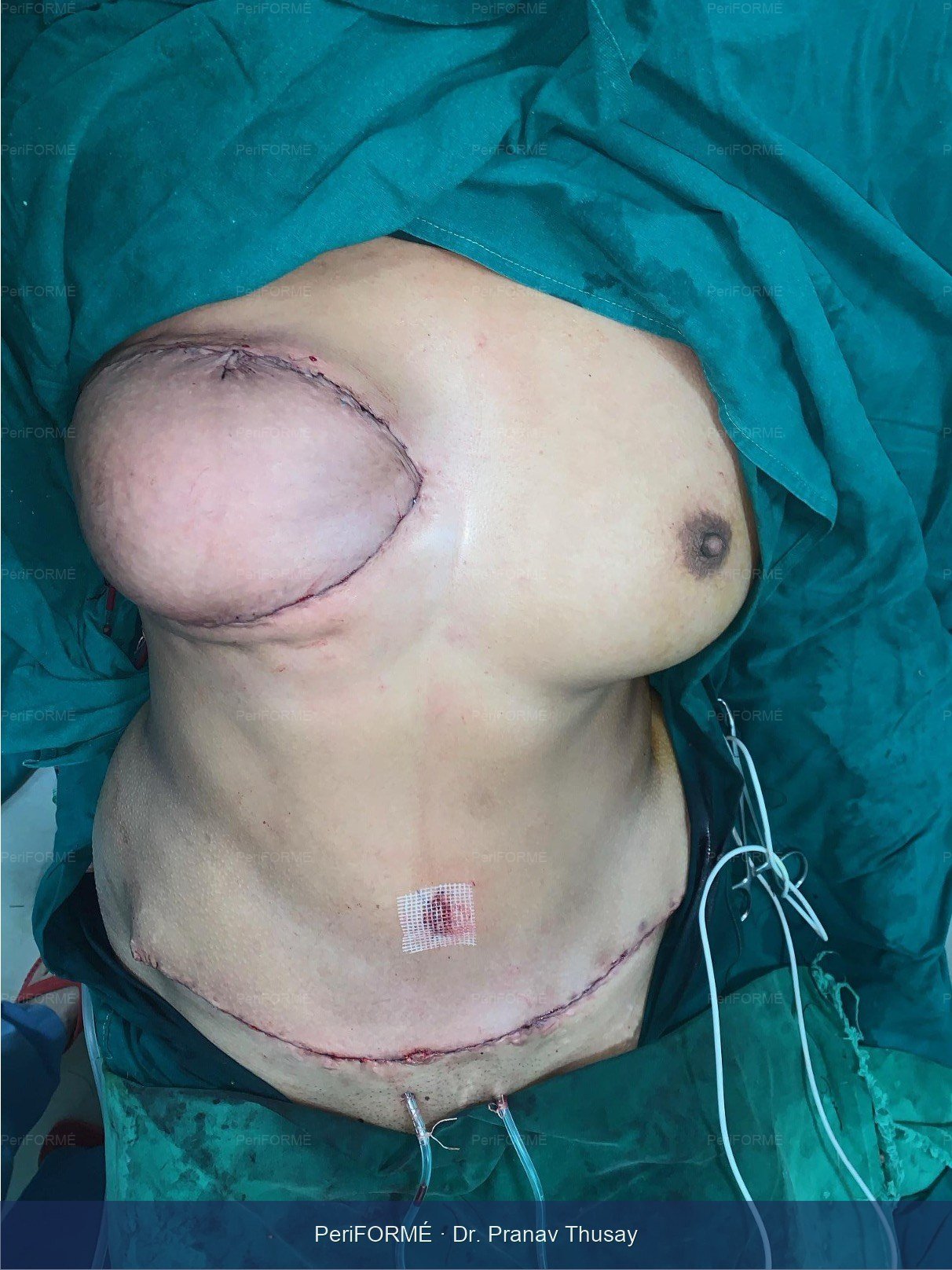 Breast Reconstruction — After