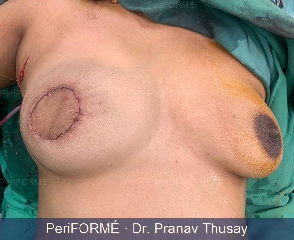 Breast Reconstruction — After