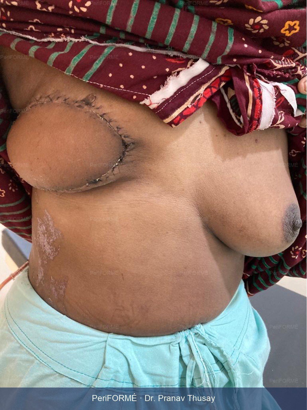 Breast Reconstruction — After