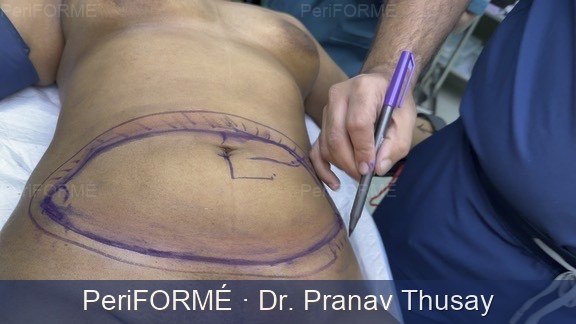 Breast reconstruction after Cancer surgery - forming new breast trissue — Before