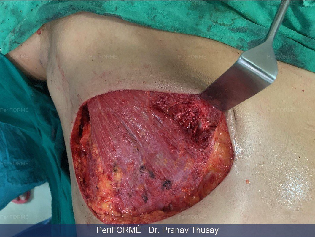 Breast Reconstruction — Before