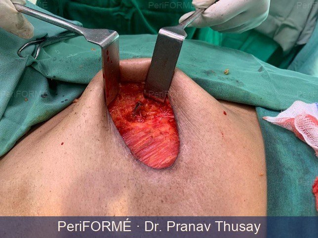 Breast Reconstruction — Before