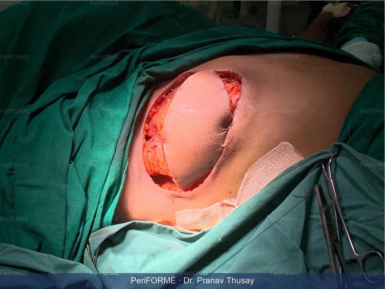 Breast Reconstruction — Before