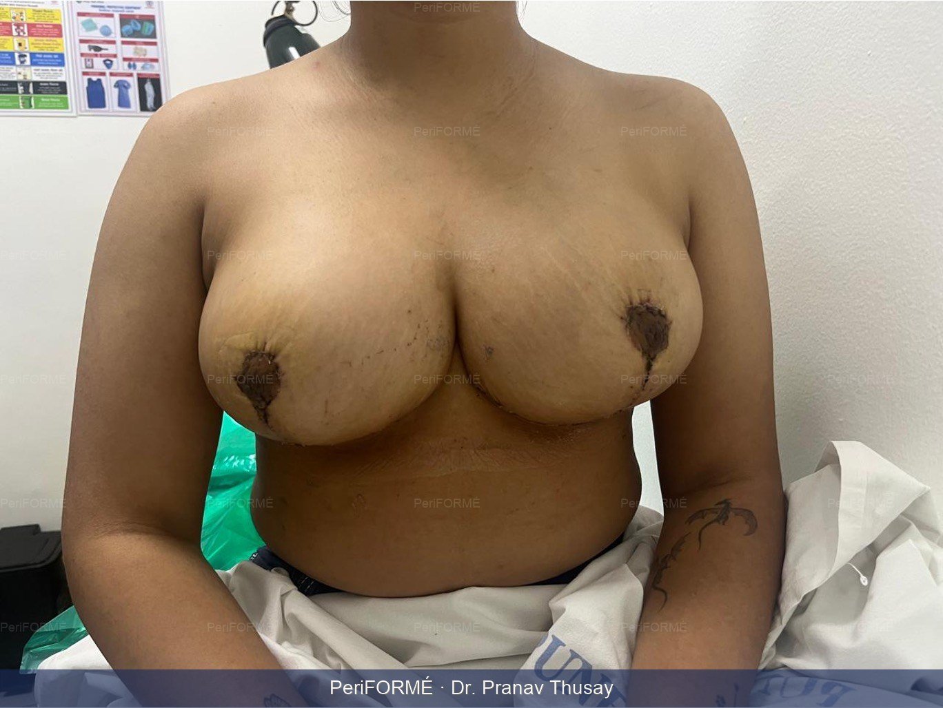 Breast reduction — After