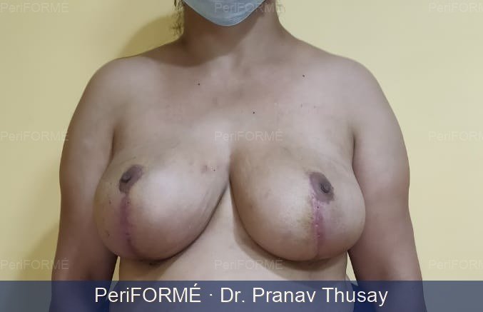 Breast reduction — After