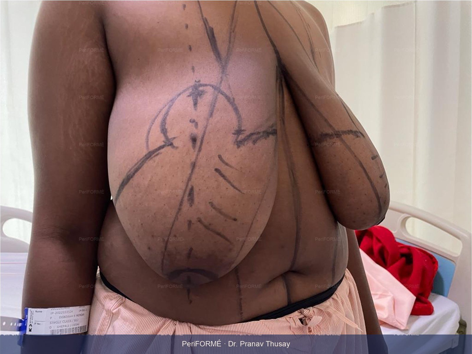 Breast reduction — Before