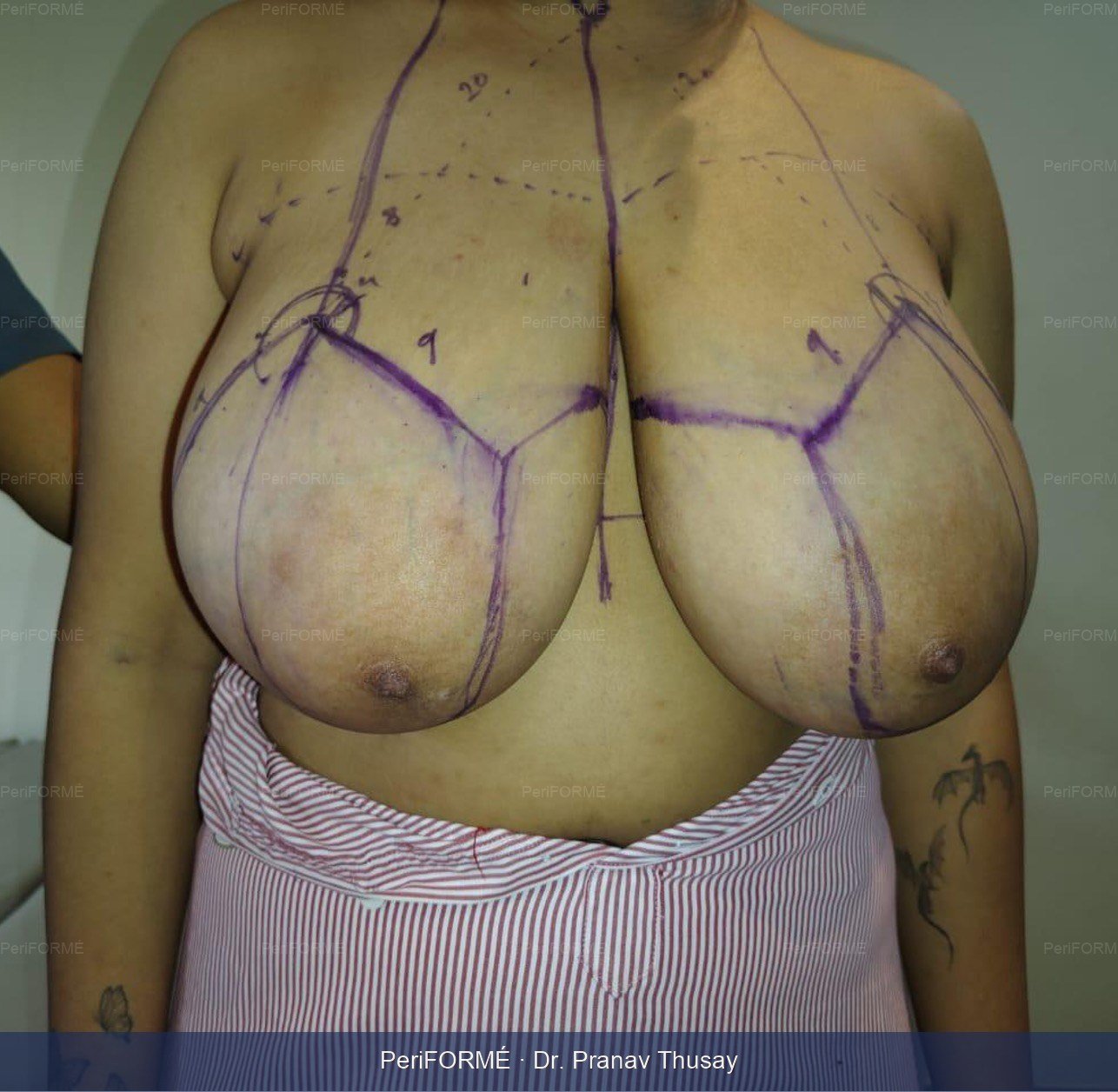 Breast reduction — Before