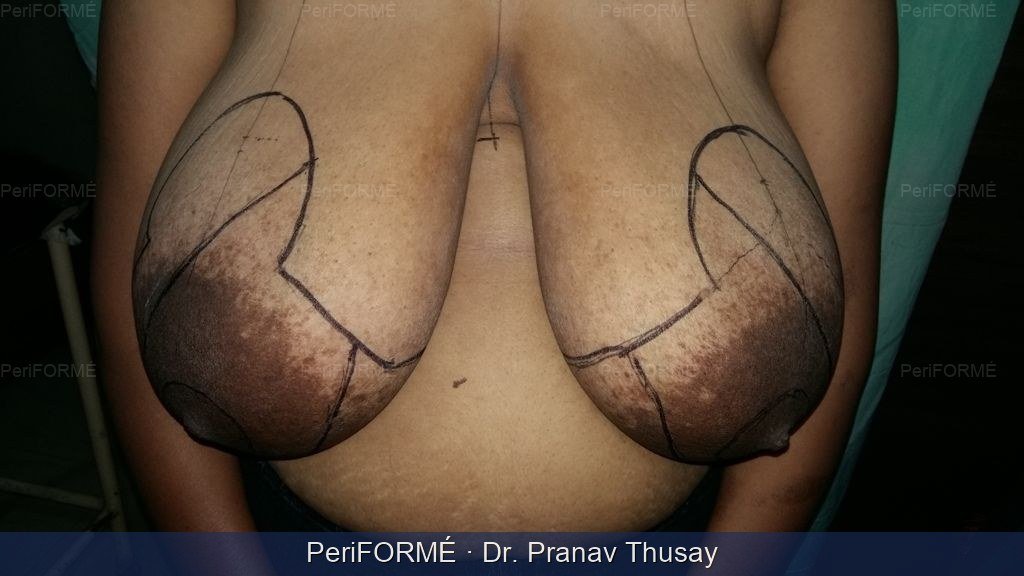 Breast reduction — Before