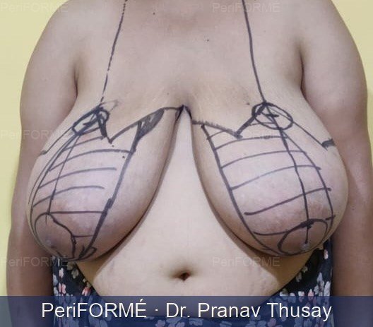 Breast reduction — Before