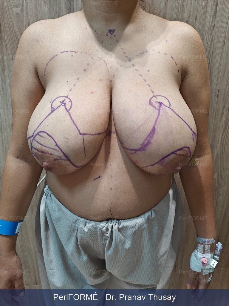 Breast reduction surgery - day 7 photo after surgery — Before