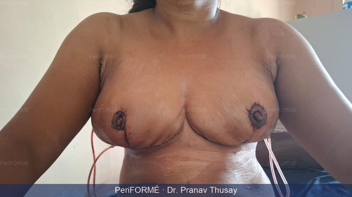 Breast reduction surgery - immediate day 3 picture — After