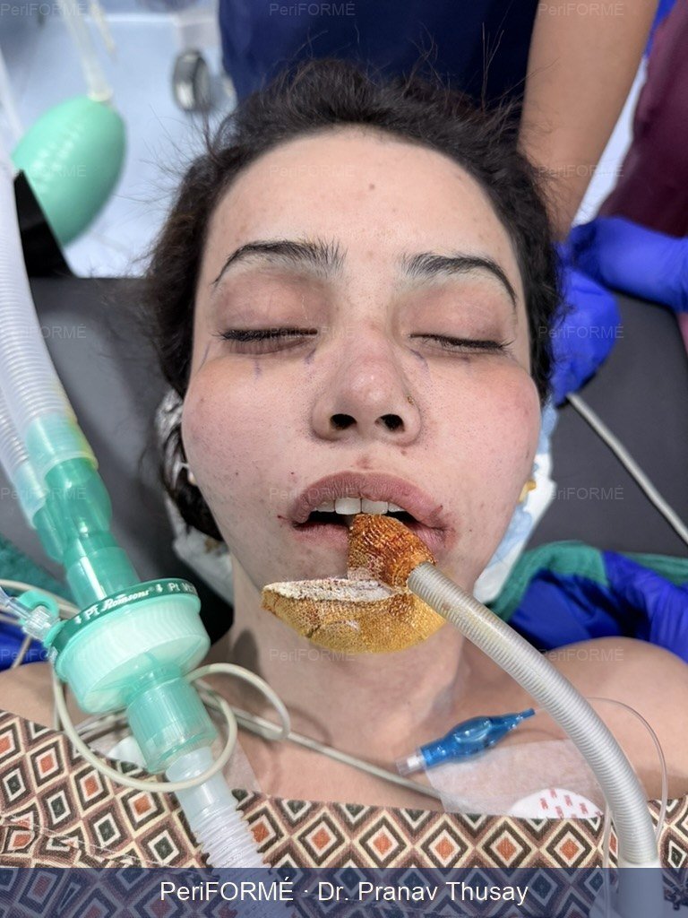 Cheek Augmentation - Malar Implant — After
