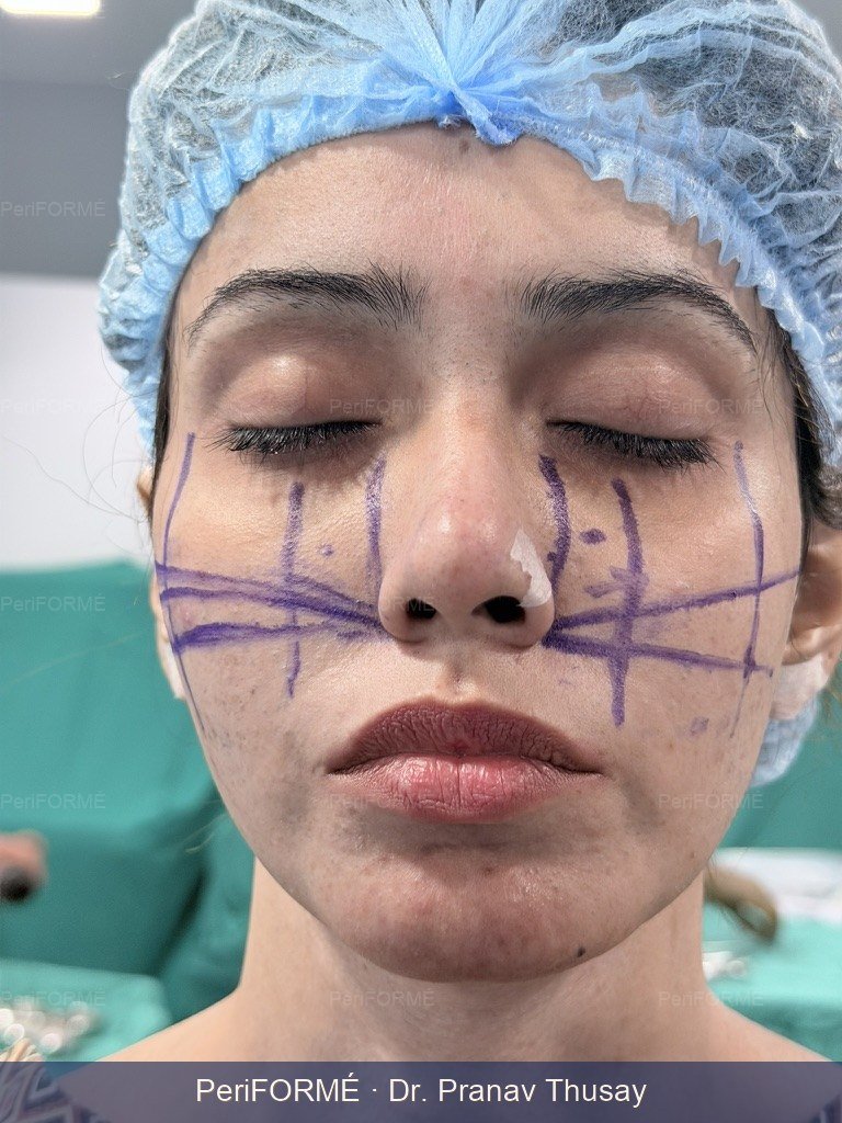 Cheek Augmentation - Malar Implant — Before
