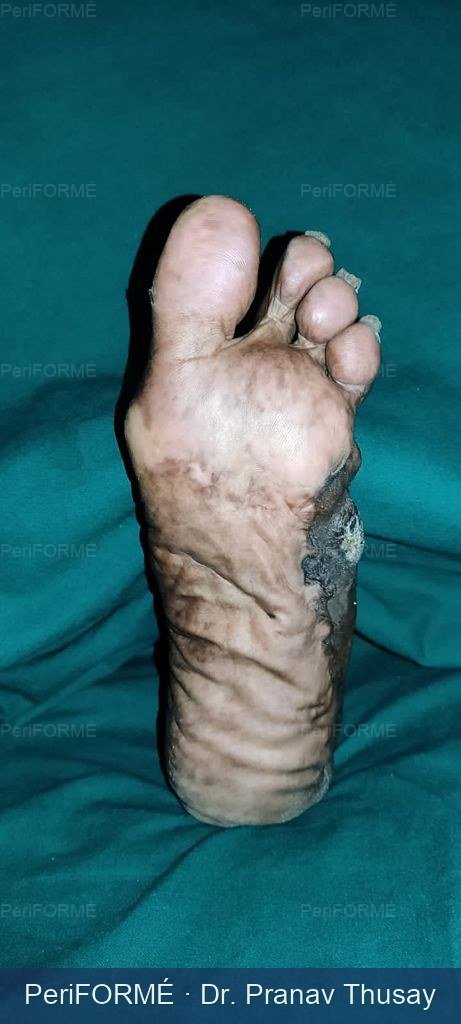 Coverage of foot defect — After