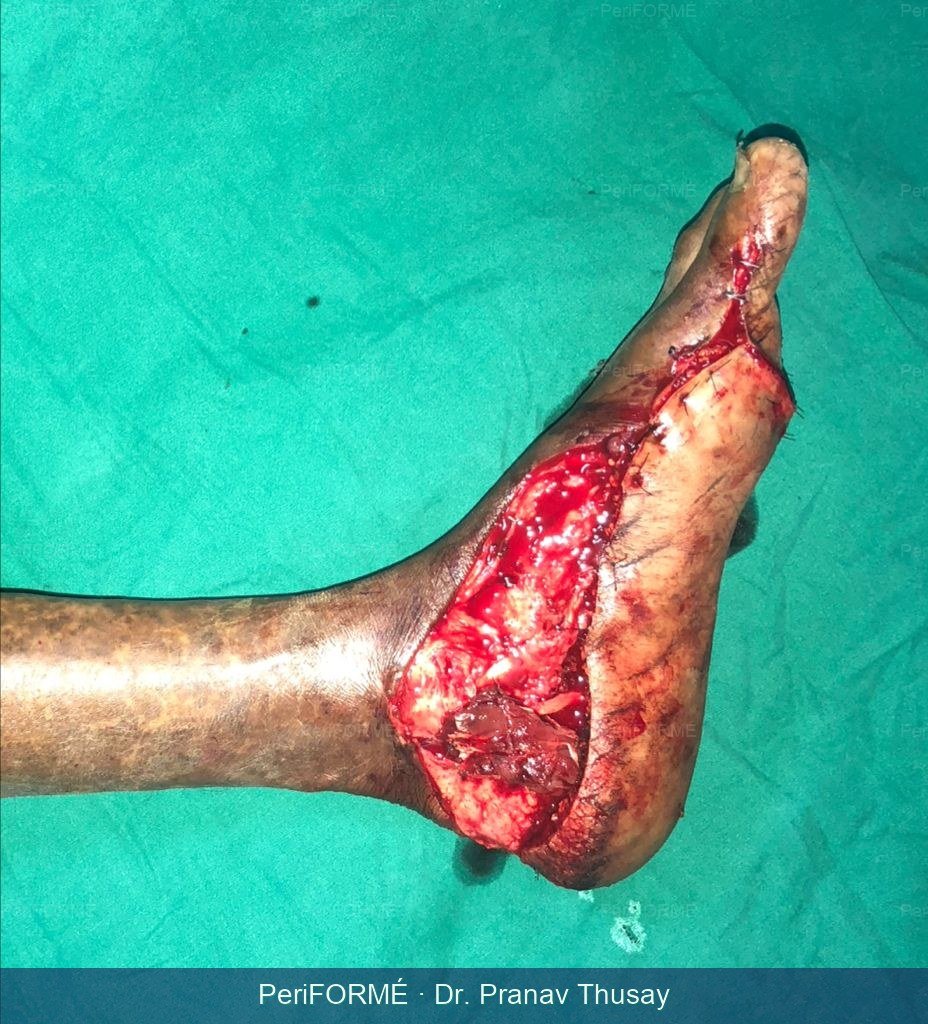Coverage of foot defect — Before