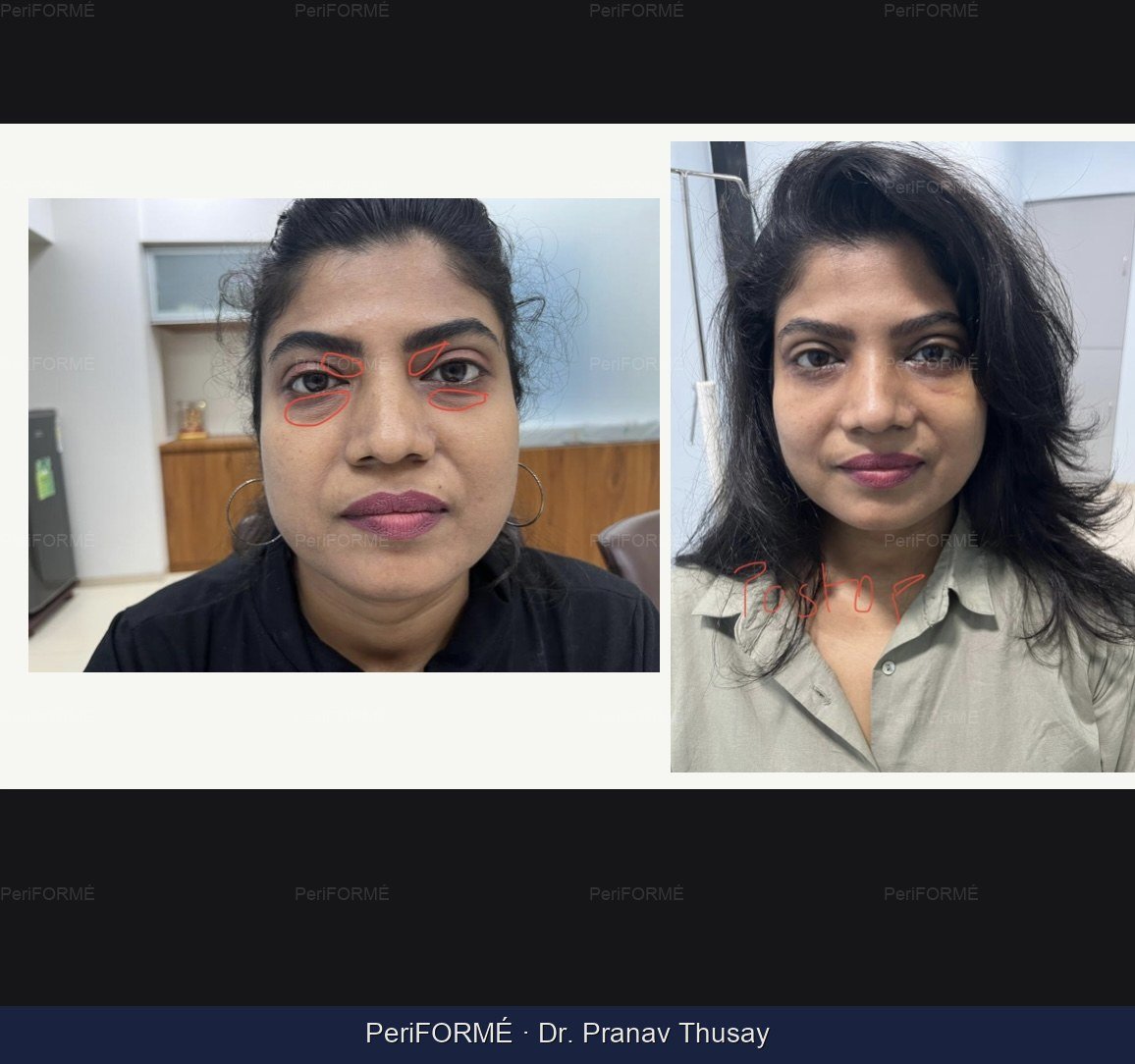 Eyelid surgery - Blepharoplasty surgery