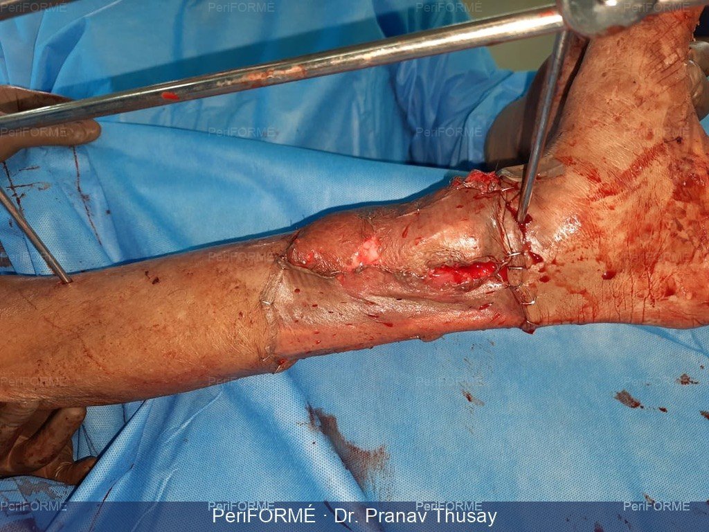 Flap coverage for wound defect — After