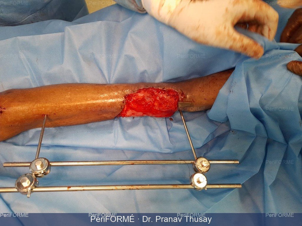 Flap coverage for wound defect — Before
