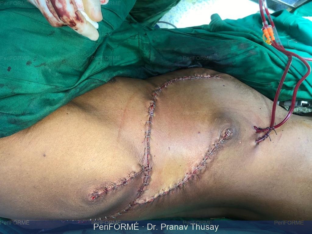 Flap surgery — After