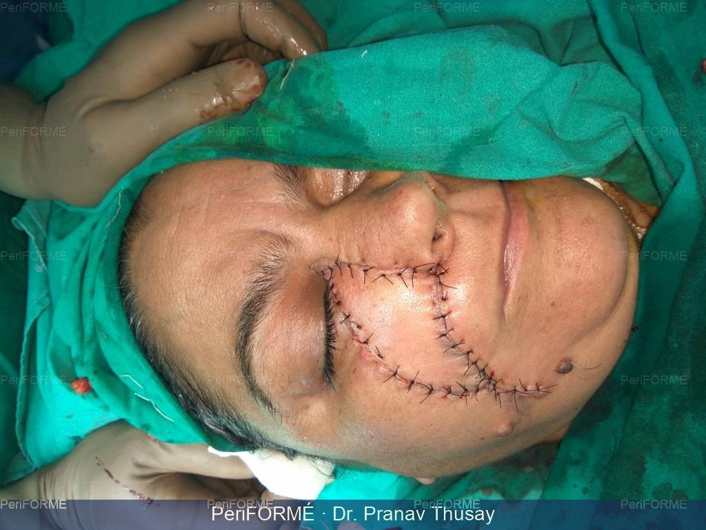 Flap surgery — After