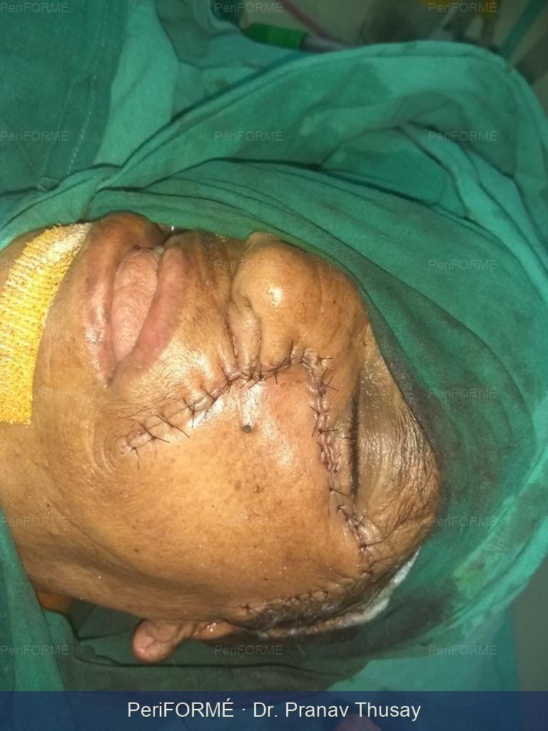 Flap surgery — After