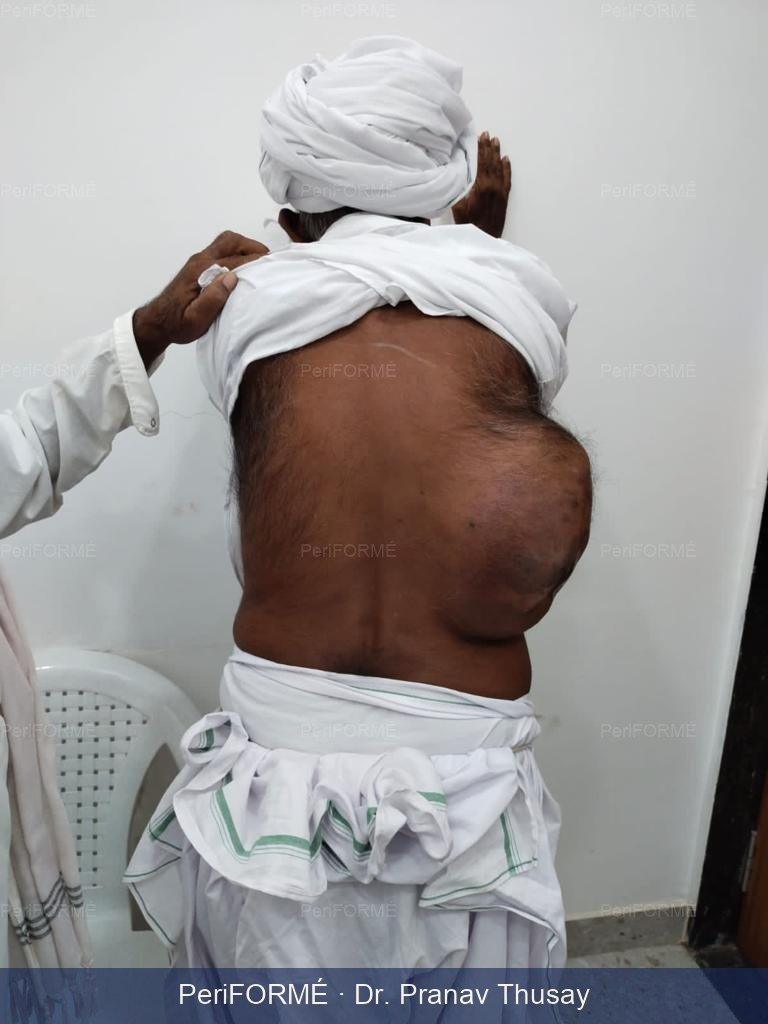Flap surgery — Before