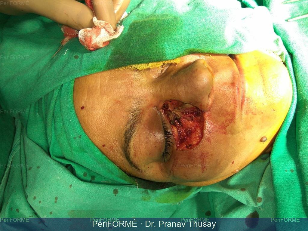 Flap surgery — Before