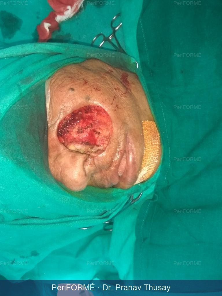 Flap surgery — Before