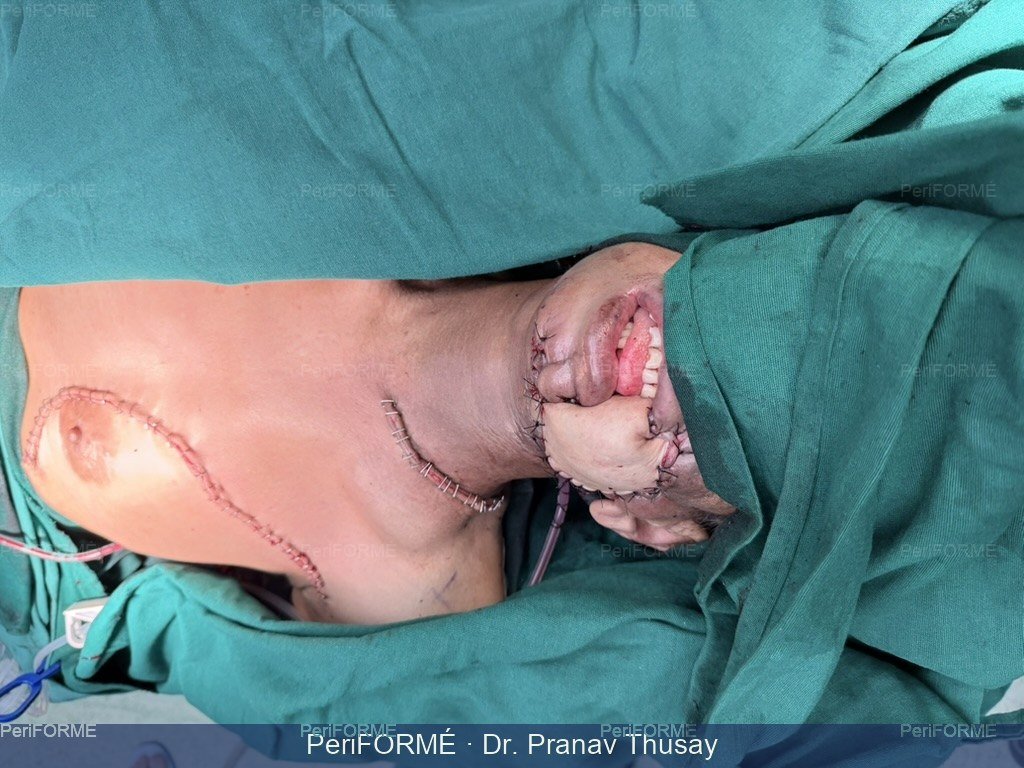 Flap surgery to rehabilitate the patient — After
