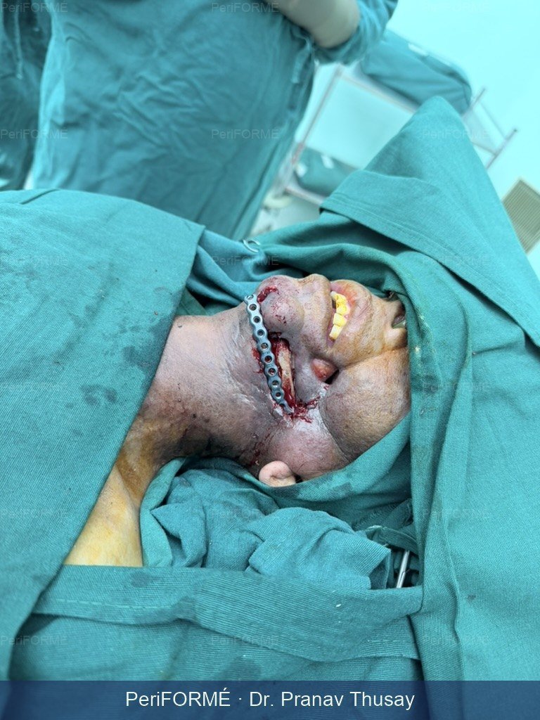 Flap surgery to rehabilitate the patient — Before
