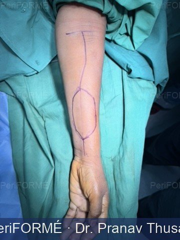 Free radial artery forearm flap markings - Advanced microsurgery