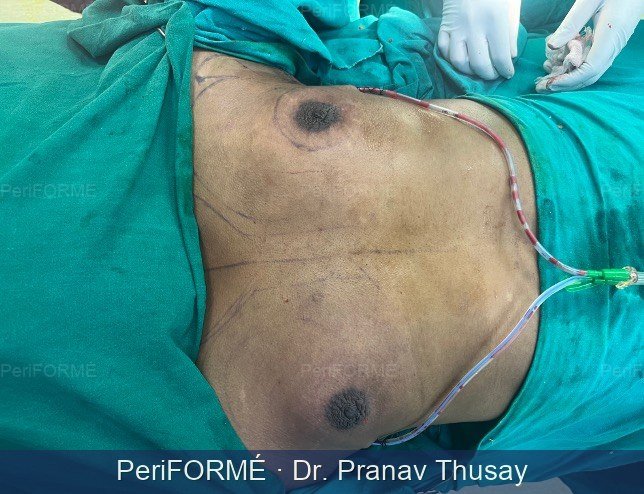 Gynaecomastia — After