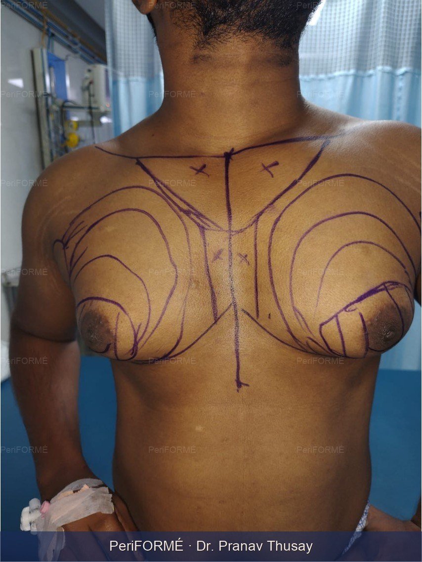 Gynaecomastia — Before
