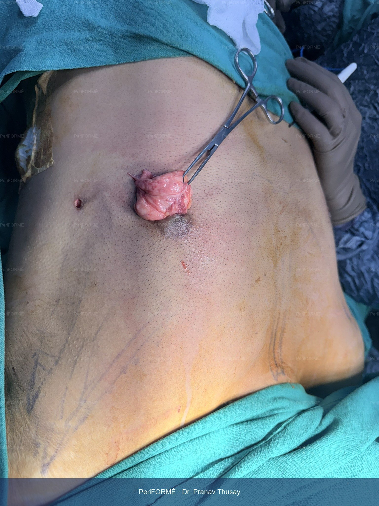 Gynaecomastia - Gland excision