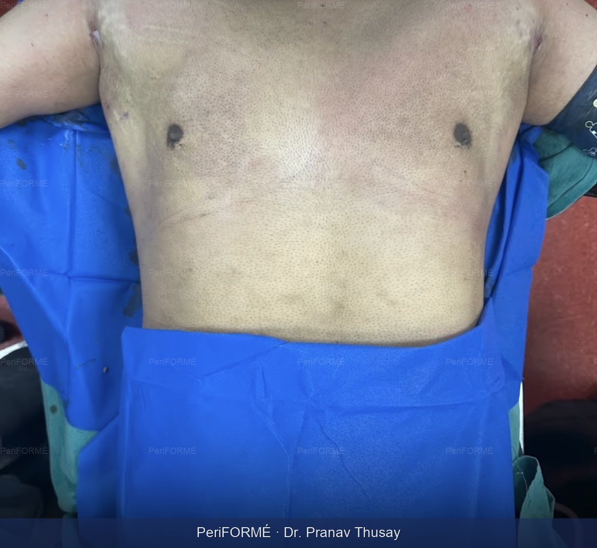 Gynaecomastia liposuction scarless — After